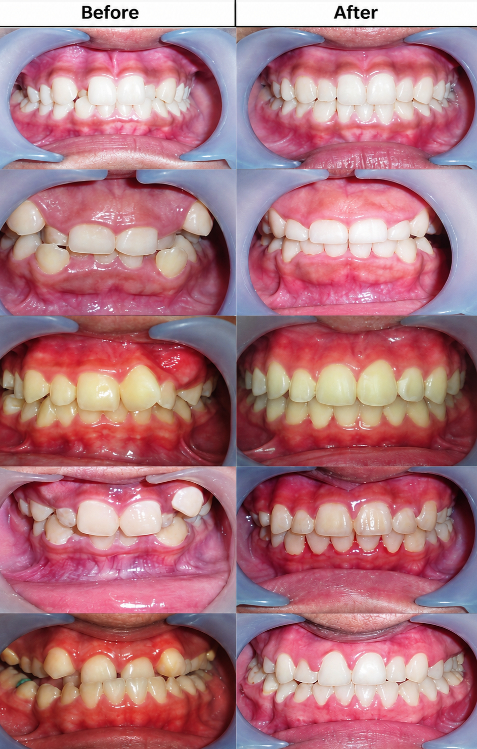 Full Smile Veneer Perfecting